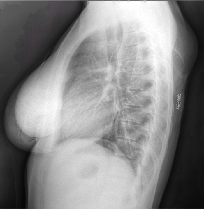  A black and white ultrasound image of a female torso in profile.