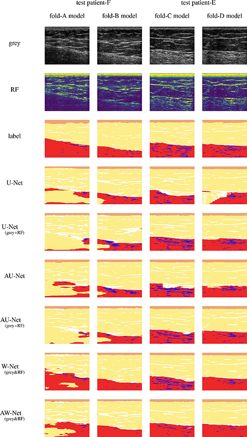  Ultrasound images in black and white top a grid of blocks that show how the W-Net convolutional neural network makes the images clearer with red, light yellow and blue highlighting specific areas in the ultrasound.